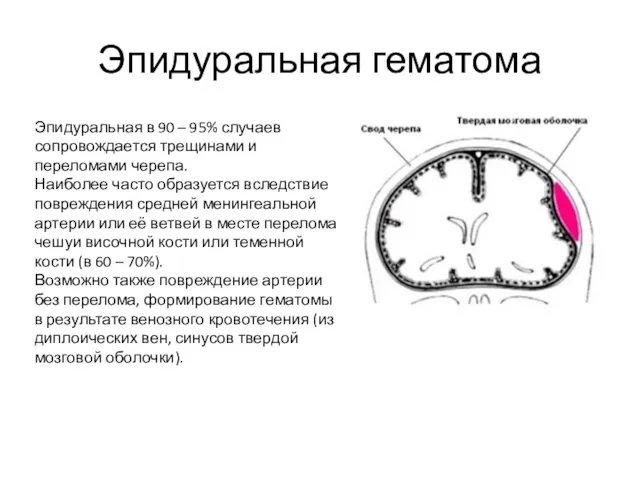 Эпидуральная гематома Эпидуральная в 90 – 95% случаев сопровождается трещинами