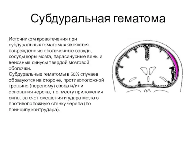 Субдуральная гематома Источником кровотечения при субдуральных гематомах являются поврежденные оболочечные