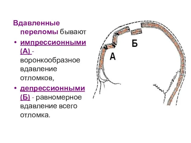 Вдавленные переломы бывают импрессионными (А) - воронкообразное вдавление отломков, депрессионными (Б) - равномерное вдавление всего отломка.