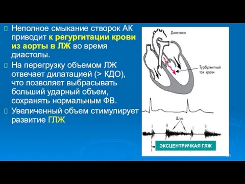 Неполное смыкание створок АК приводит к регургитации крови из аорты