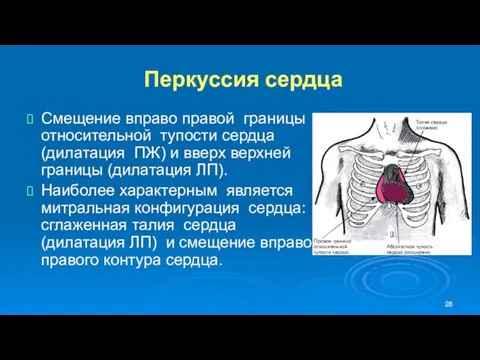 Перкуссия сердца Смещение вправо правой границы относительной тупости сердца (дилатация