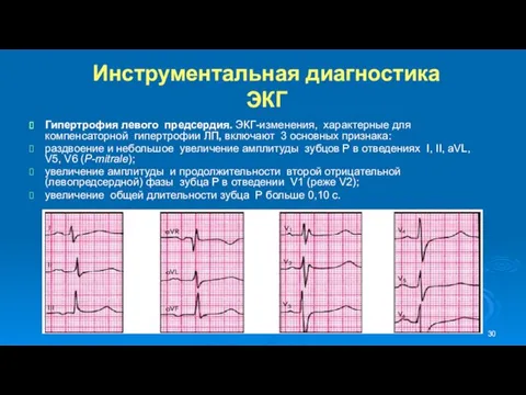 Инструментальная диагностика ЭКГ Гипертрофия левого предсердия. ЭКГ-изменения, характерные для компенсаторной