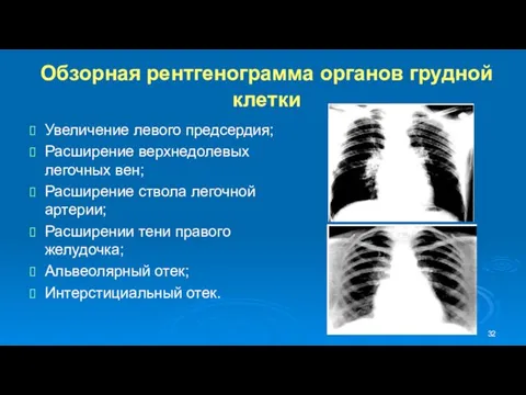 Обзорная рентгенограмма органов грудной клетки Увеличение левого предсердия; Расширение верхнедолевых