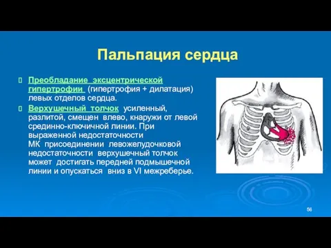 Пальпация сердца Преобладание эксцентрической гипертрофии (гипертрофия + дилатация) левых отделов