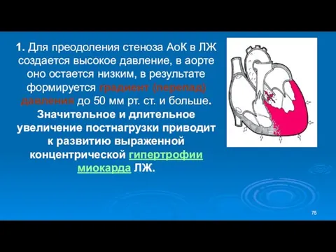 1. Для преодоления стеноза АоК в ЛЖ создается высокое давление,