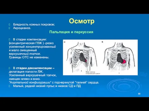 Осмотр Бледность кожных покровов; Акроцианоз. Пальпация и перкуссия В стадии