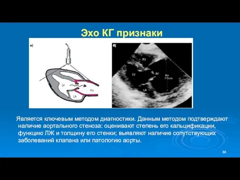 Эхо КГ признаки Является ключевым методом диагностики. Данным методом подтверждают