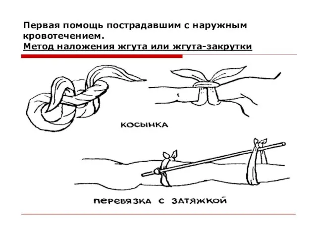 Первая помощь пострадавшим с наружным кровотечением. Метод наложения жгута или жгута-закрутки