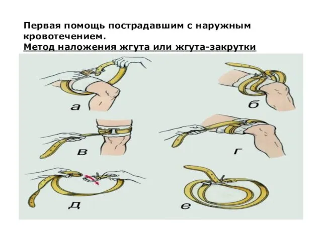 Первая помощь пострадавшим с наружным кровотечением. Метод наложения жгута или жгута-закрутки