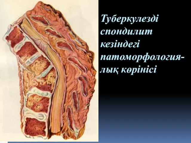 Туберкулезді спондилит кезіндегі патоморфология-лық көрінісі