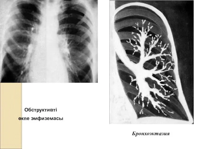 Обструктивті өкпе эмфиземасы Бронхоэктазия