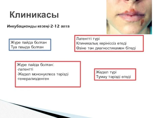 Клиникасы Инкубационды кезеңі-2-12 апта Жүре пайда болған Туа паыда болған