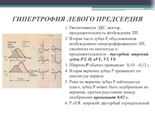 ГИПЕРТРОФИЯ ЛЕВОГО ПРЕДСЕРДИЯ 1. Увеличивается ЭДС, вектор, продолжительность возбуждения ЛП.