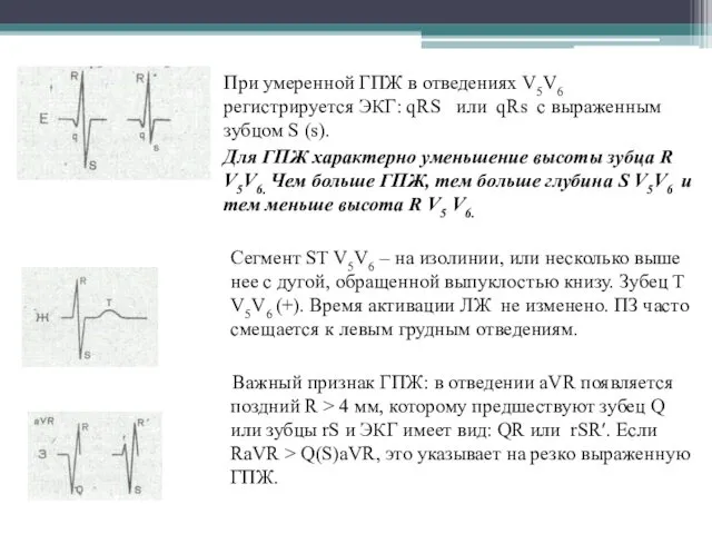 При умеренной ГПЖ в отведениях V5V6 регистрируется ЭКГ: qRS или