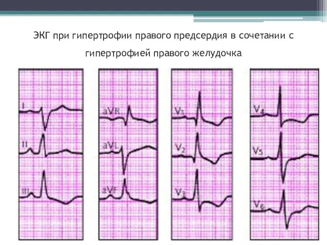 ЭКГ при гипертрофии правого предсердия в сочетании с гипертрофией правого желудочка