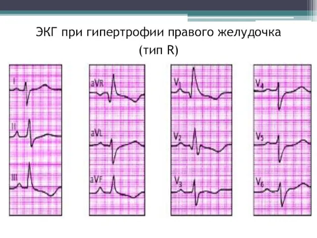 ЭКГ при гипертрофии правого желудочка (тип R)