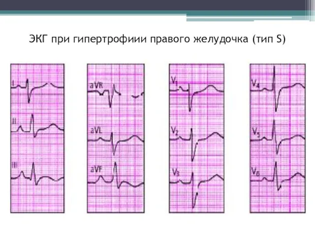 ЭКГ при гипертрофиии правого желудочка (тип S)