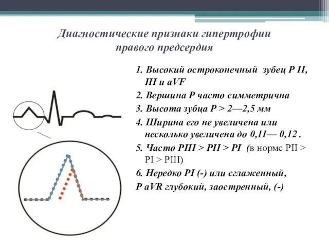 Диагностические признаки гипертрофии правого предсердия 1. Высокий остроконечный зубец Р