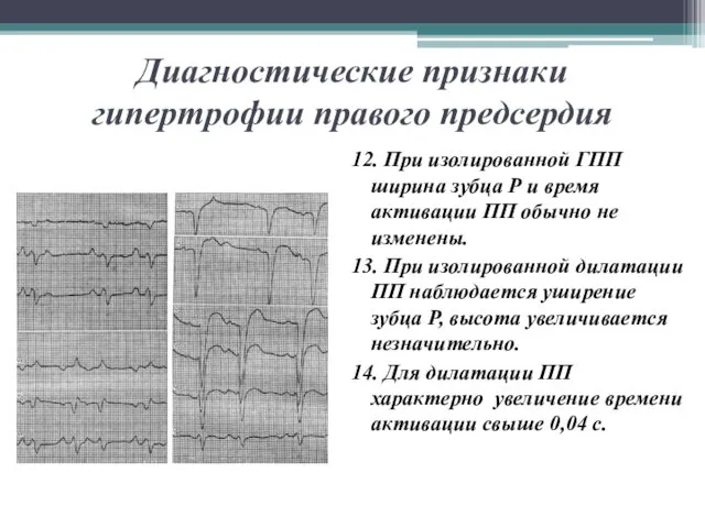 Диагностические признаки гипертрофии правого предсердия 12. При изолированной ГПП ширина