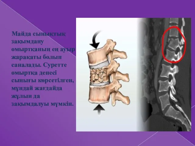 Майда сынықтық зақымдану омыртқаның ең ауыр жарақаты болып саналады. Суретте