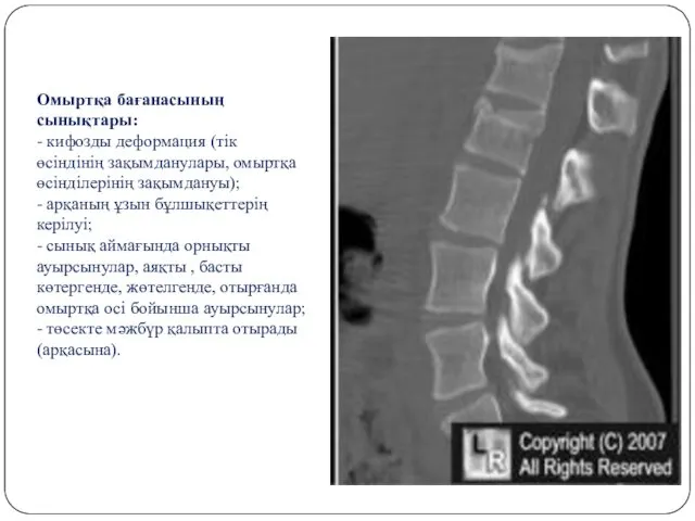 Омыртқа бағанасының сынықтары: - кифозды деформация (тік өсіндінің зақымданулары, омыртқа