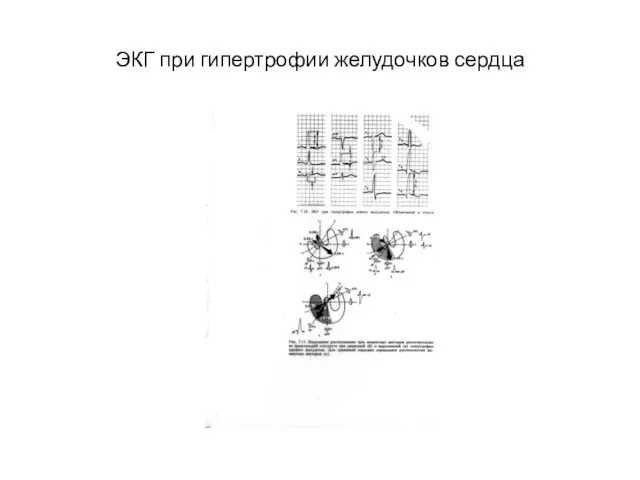 ЭКГ при гипертрофии желудочков сердца