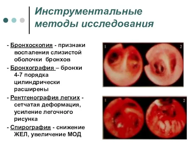 Инструментальные методы исследования - Бронхоскопия - признаки воспаления слизистой оболочки