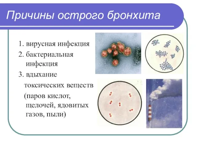 Причины острого бронхита 1. вирусная инфекция 2. бактериальная инфекция 3.