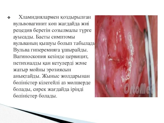 Хламидиялармен қоздырылған вульвовагинит көп жағдайда жиі рецедив беретін созылмалы түрге