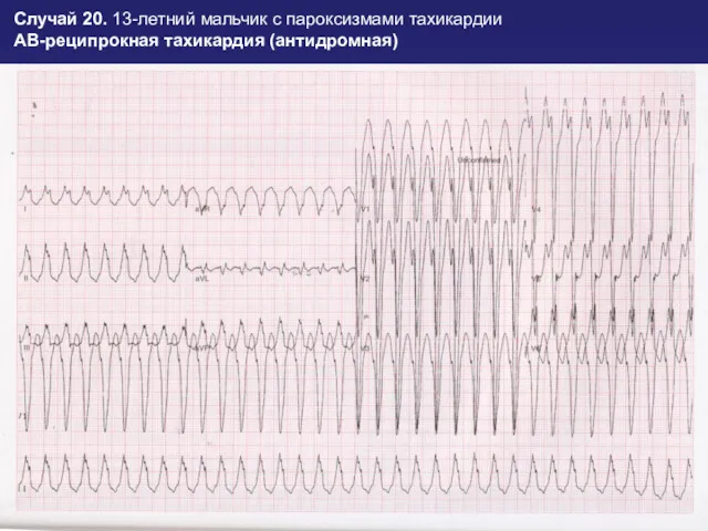 Случай 20. 13-летний мальчик с пароксизмами тахикардии АВ-реципрокная тахикардия (антидромная)