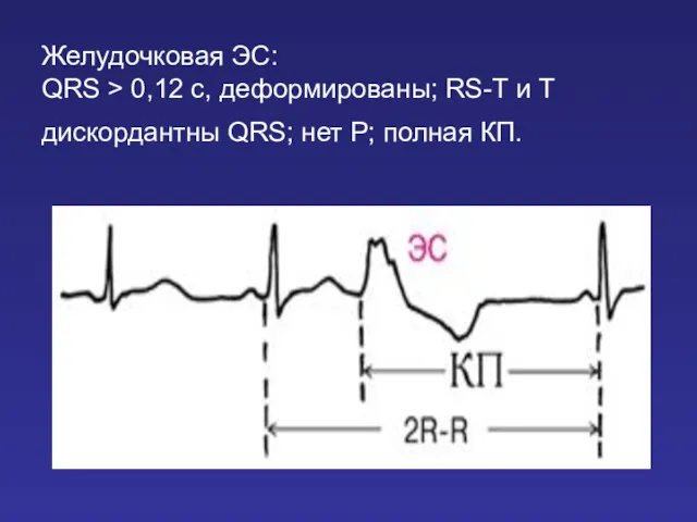 Желудочковая ЭС: QRS > 0,12 c, деформированы; RS-T и Т дискордантны QRS; нет Р; полная КП.