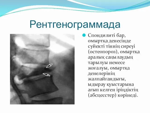Рентгенограммада Спондилиті бар, омыртқа денесінде суйекті тіннің сиреуі (остеопороз), омыртқа