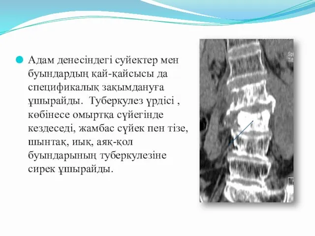 Адам денесіндегі суйектер мен буындардың қай-қайсысы да спецификалық зақымдануға ұшырайды.