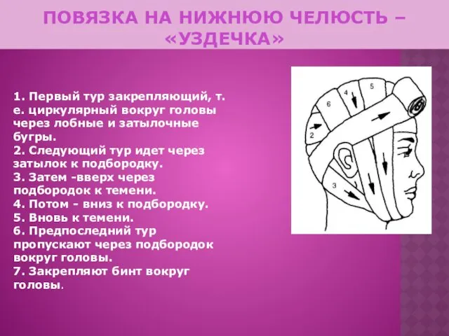 ПОВЯЗКА НА НИЖНЮЮ ЧЕЛЮСТЬ – «УЗДЕЧКА» 1. Первый тур закрепляющий,