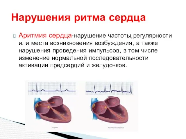 Аритмия сердца-нарушение частоты,регулярности или места возникновения возбуждения, а также нарушения