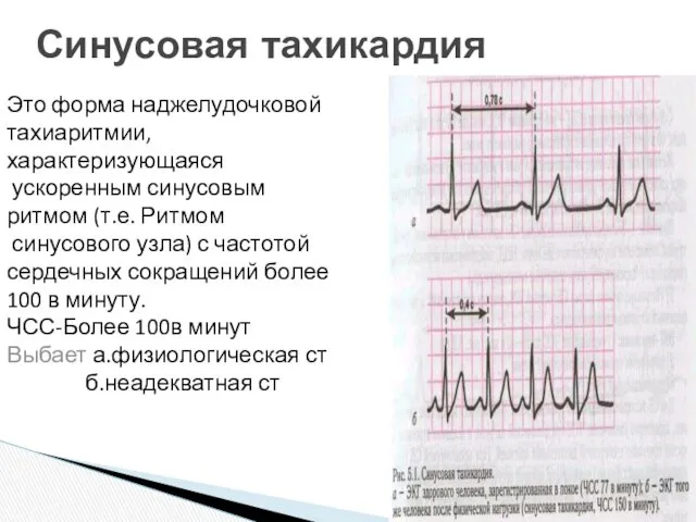 Это форма наджелудочковой тахиаритмии, характеризующаяся ускоренным синусовым ритмом (т.е. Ритмом