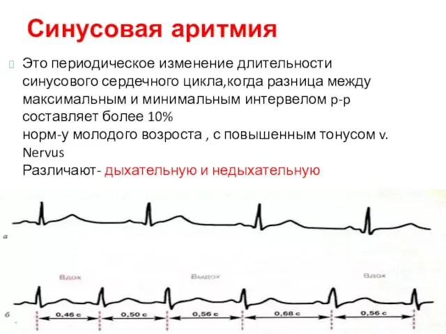 Это периодическое изменение длительности синусового сердечного цикла,когда разница между максимальным