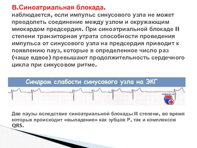 В.Синоатриальная блокада. наблюдается, если импульс синусового узла не может преодолеть