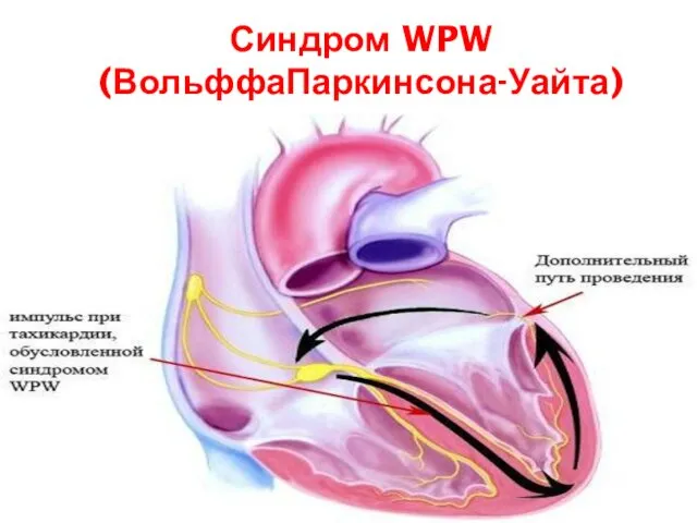 Синдром WPW (ВольффаПаркинсона-Уайта)