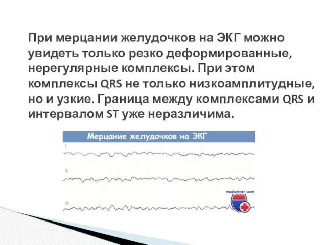 При мерцании желудочков на ЭКГ можно увидеть только резко деформированные,