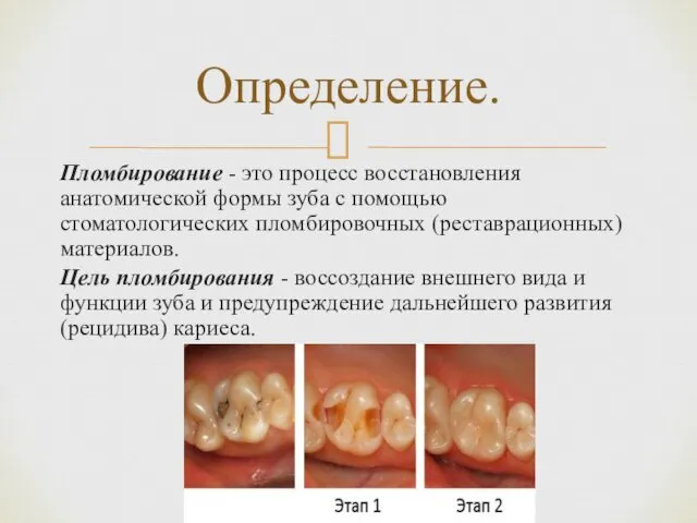 Пломбирование - это процесс восстановления анатомической формы зуба с помощью