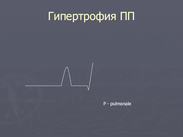 Гипертрофия ПП Р - pulmonale