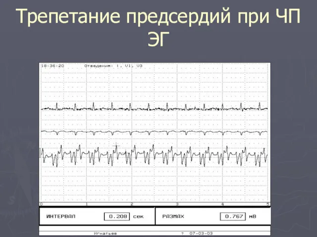 Трепетание предсердий при ЧП ЭГ