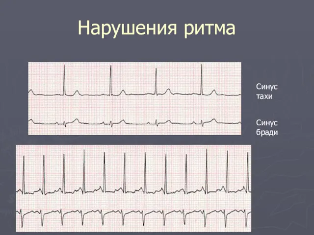 Нарушения ритма Синус тахи Синус бради