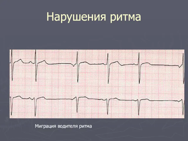 Нарушения ритма Миграция водителя ритма