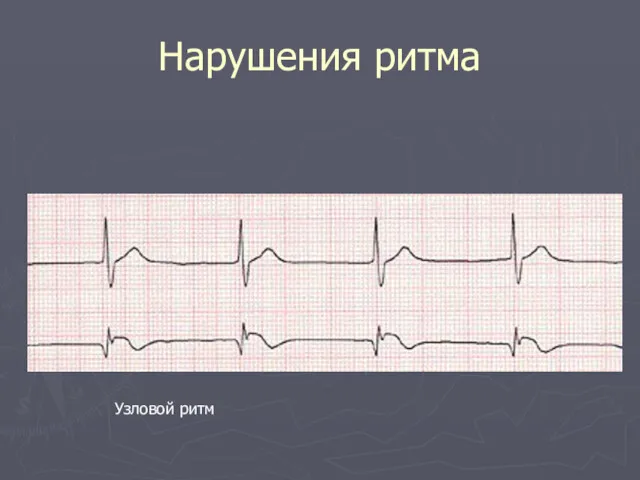 Нарушения ритма Узловой ритм