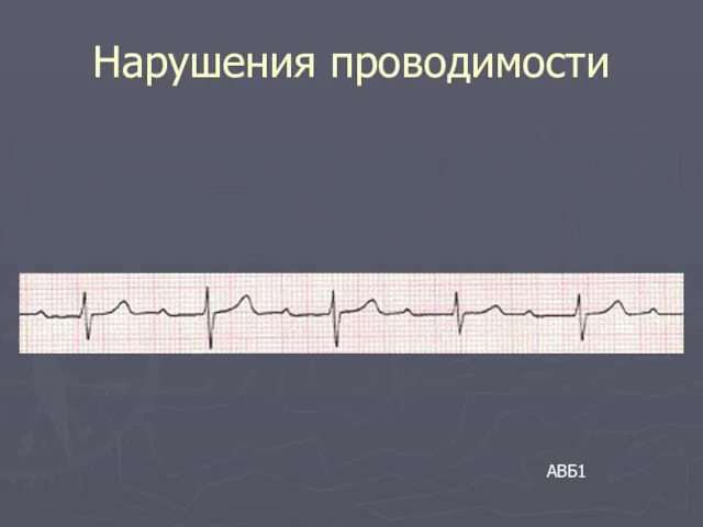 Нарушения проводимости АВБ1