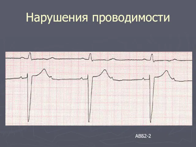 Нарушения проводимости АВБ2-2