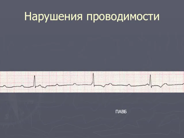 Нарушения проводимости ПАВБ