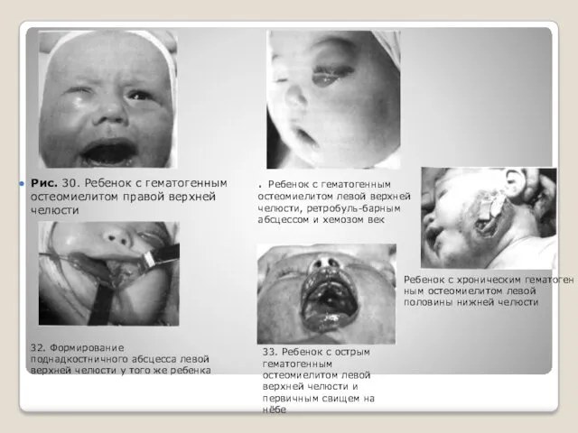 Рис. 30. Ребенок с гематогенным остеомие­литом правой верхней челюсти . Ребенок с гематогенным